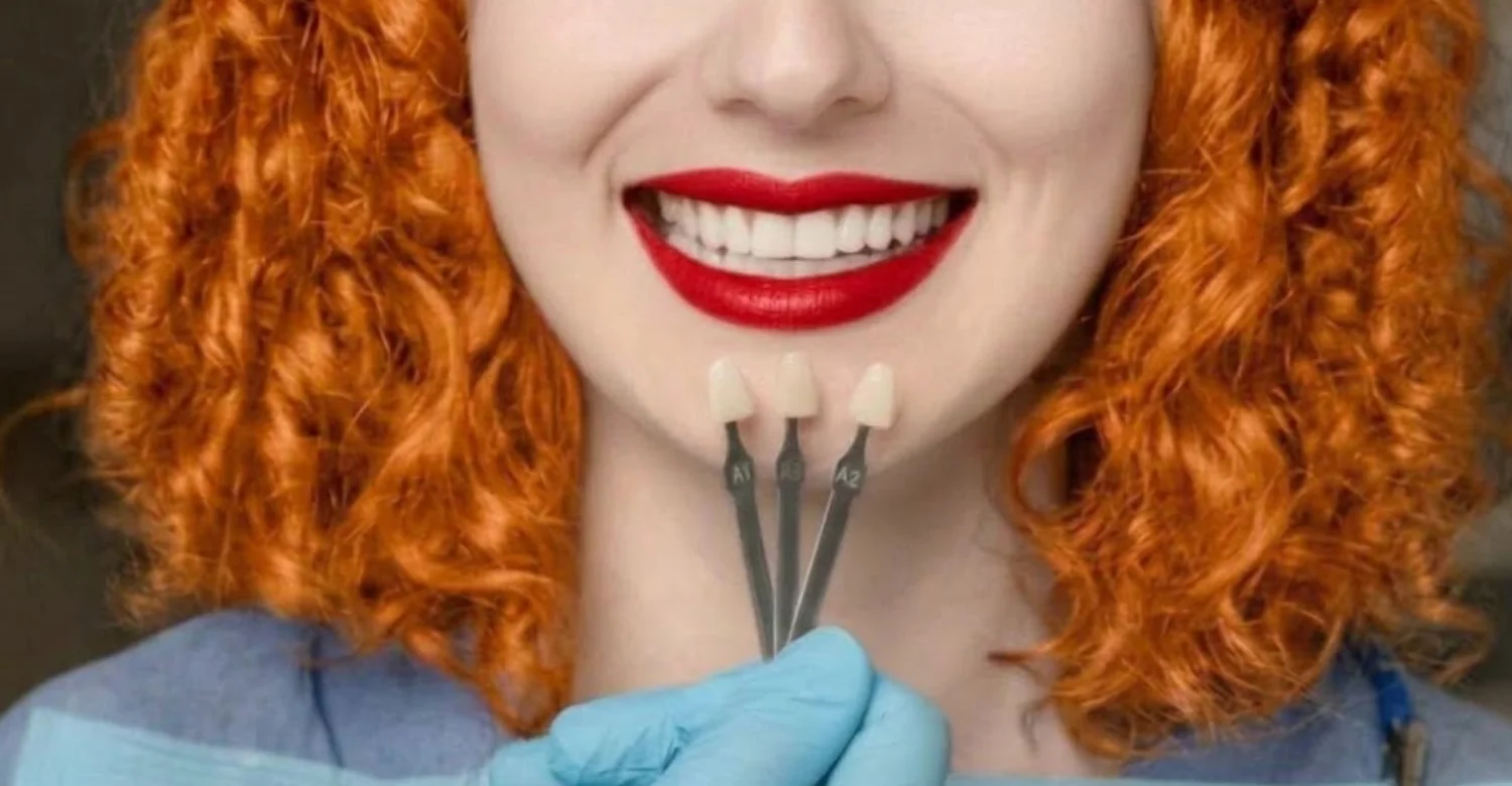 Dental Veneers Benefits inblog